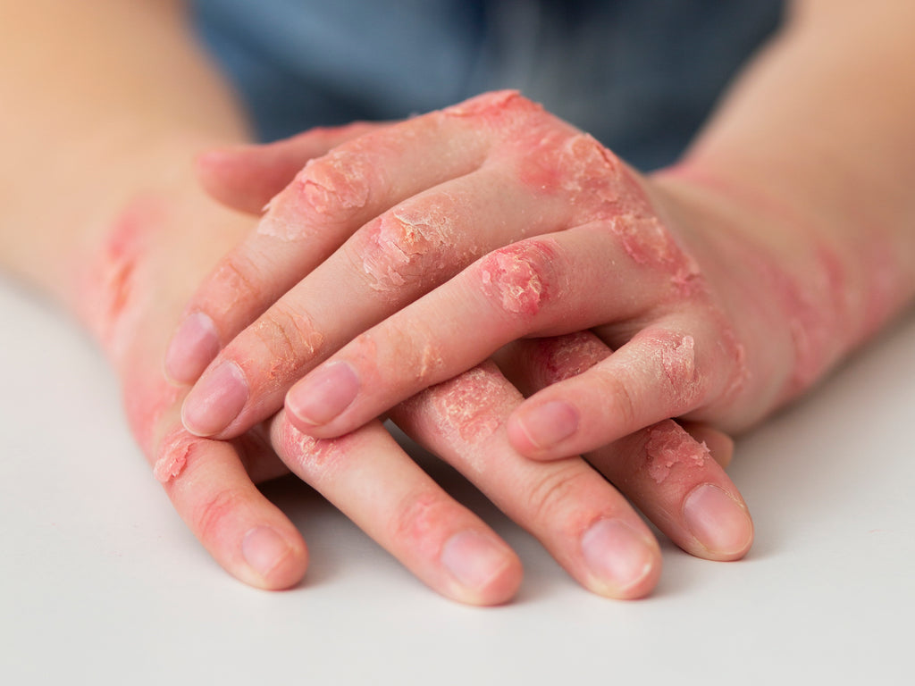 How To Heal Your Psoriasis Naturally – Gutology