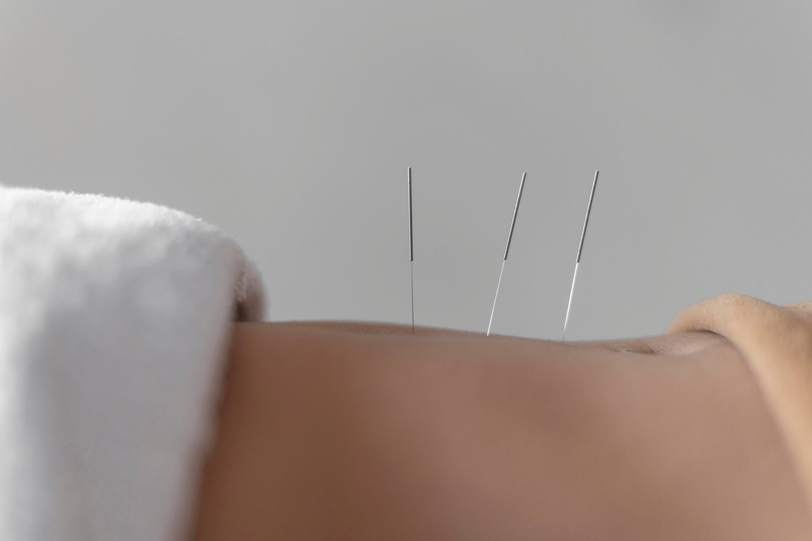 How Acupuncture Can Transform Your Gut Health